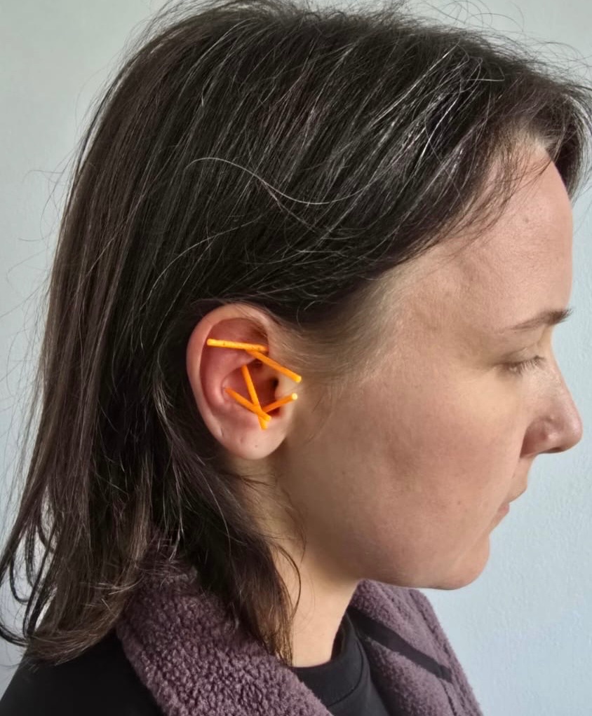 Female patient receiving NADA ear acupuncture treatment